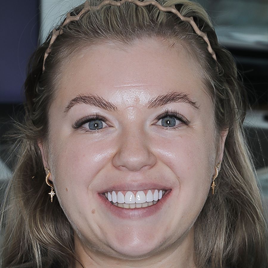 Composite veneers - after - Shannen - 3dental